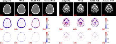 CT synthesis from MRI with an improved multi-scale learning network